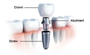 임플란트-구성요소