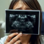 Do I need to extract the wisdom tooth for a sinus lift